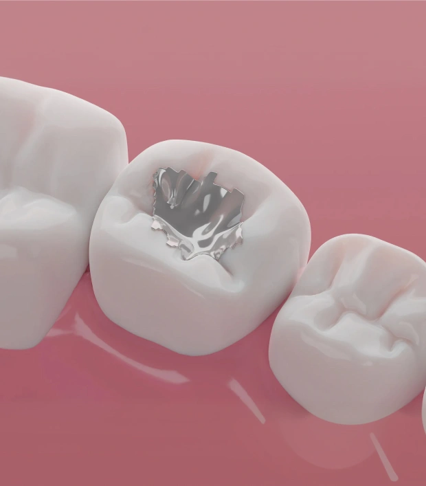 Give Your Smile a Boost With Dental Fillings