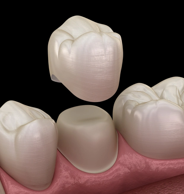 Eliminate Chips and Cracks With Dental Crowns