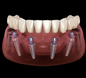 All-on-4® Dental Implants