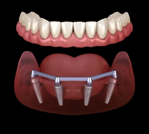 Hybrid Implant Dentures