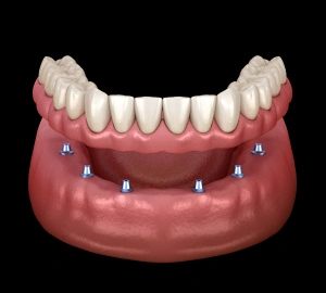 Implant Retained Dentures