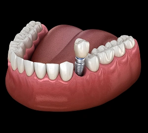 Single Tooth Dental Implant