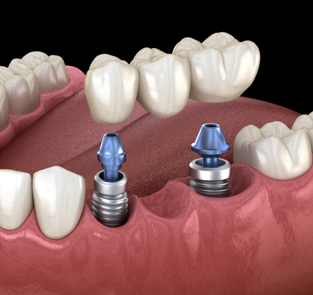 What Are Single Tooth Implants and Bridges