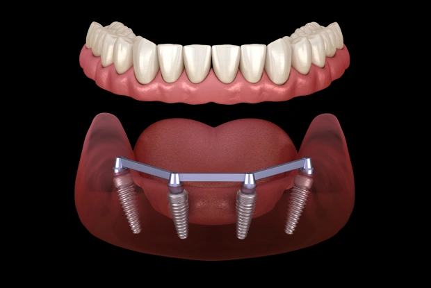 What are All-On-4 Implants